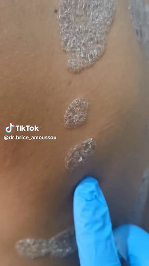 Comprendre le psoriasis : symptômes et traitements