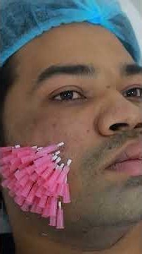 PDO Thread Lift for Acne Scars | Combined with Mustache Hair Transplant