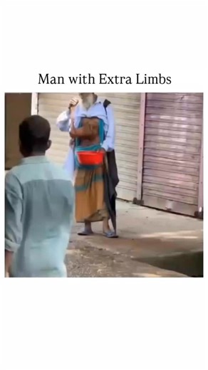 humandecod on Instagram: "A rare medical condition caused this man to be born with extra limbs protruding from his torso, a condition that has fascinated doctors and scientists around the world. . . #RareCondition #ExtraLimbs #MedicalMystery #HumanBody #UnusualButTrue #FascinatingFacts #ScienceExploring #MedicalCuriosities #RarePhenomenon #AmazingHumans"