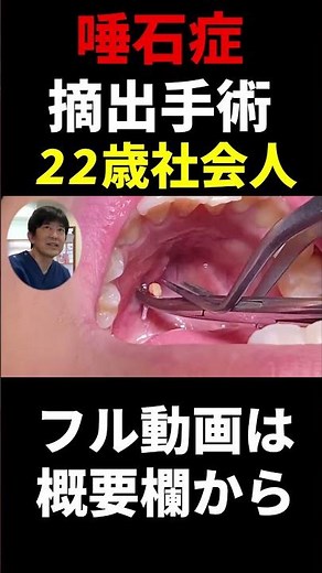 【唾石症／22歳社会人】顎下腺唾石の摘出手術（口腔外科専門医 安原豊人）#Shorts #唾石 #顎下腺唾石 #口腔外科専門医