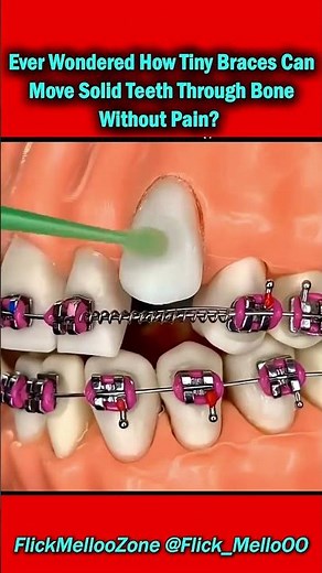 How Braces Move Teeth Through Bone Without Pain 😳 | The Science Explained