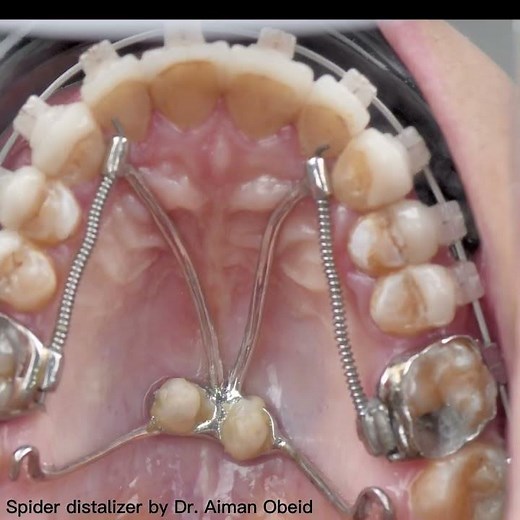 Molars distalization, Spider distalizer using palatal #tads by Dr. Aiman Obeid
