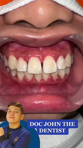 Understanding Composite Bonding for Dental Care
