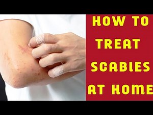 HOW TO TREAT SCABIES? | scabies treatment at home || skin care | skin infection | Sarcoptes scabiei