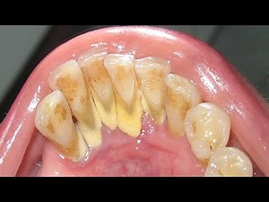 Heavy Calculus Tartar Removal - Dental Calaculus Removed with Ultrasonic Scaler #14 🦷 DentalHealth