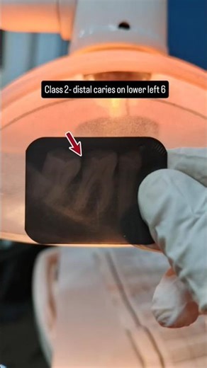 Class 2 composite restoration #shorts