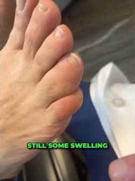 This Toe Injury Was Finally Healed! ⚡🦶