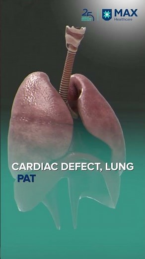 Blue Baby Syndrome (Cyanosis): Causes, Diagnosis, and Urgent Treatment