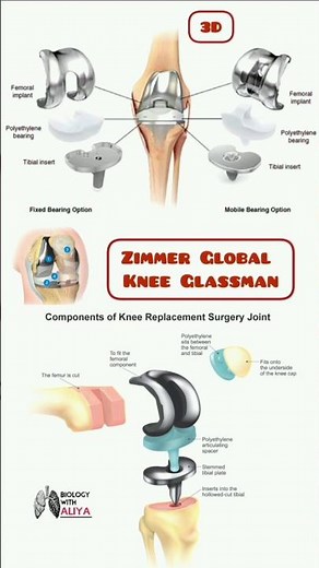 Zimmer Global Knee Glassman #shorts #knee | biology with Aliya