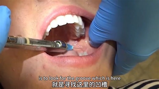 下颌阻滞麻醉IANB，短针头by:hygiene edge