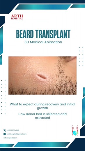 Beard Transplant Explained | 3D Medical Animation #shorts