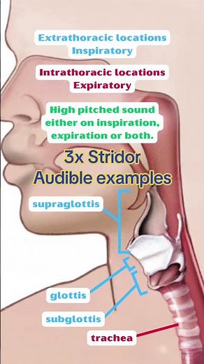 3 Audible Examples of Stridor: Causes & Symptoms #croup #stridor #epiglotitis