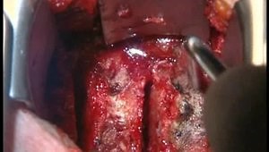 Anterior Cervical Corpectomy