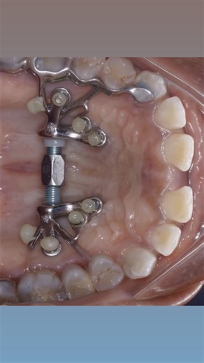 Dr. Svitlana Koval on Instagram: "Skeletal Class III correction with Midface protraction #marpeface™️ protocol #drkovalorthodontics #airwayorthodontics #airways #fme #marpe #boca #bocaraton"