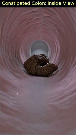What Constipation Really Looks Like: Realistic 3D Colon Footage You’ve Never Seen | 03