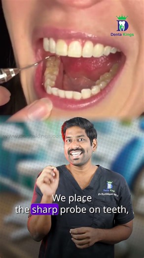 எந்த சொத்தையை அடைக்க வேண்டும் - Probing depth on decay | Dr.Karthikeyan | Denta Kings