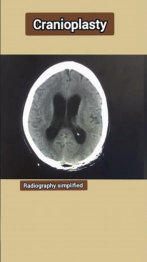 Cranioplasty ll Titanium mesh cranioplasty ll NCCT -Brain #brain #fracture #skull #shorts