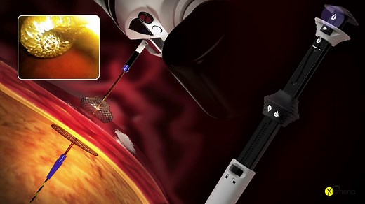 Xlumena's AXIOS Stent and Delivery System