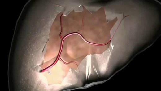 Metastase - DocCheck Flexikon