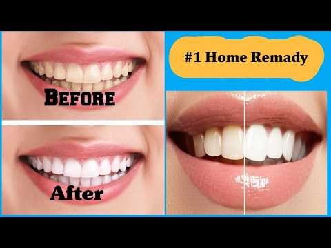 The #1 Home Remedy to Prevent Tartar FAST! (Dentist Recommended)