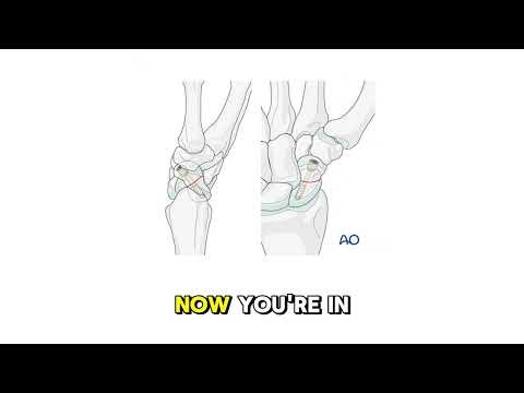 Scaphoid Fractures: Why We Miss Them And How To Fix Them