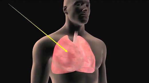 3D动画演示肺癌发病与治疗过程，莫要失去健康才后悔