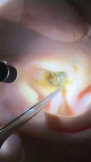 Earwax removal remove insect from ear #7