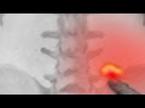 Sacroiliac Episacral Lipoma Subfascial fat Herniation - BACK MICE underdiagnosed cause of Backache