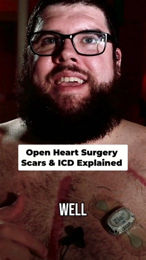 Heart Surgery Scars & ICD Device: My Lifesaving Tech Explained #shorts