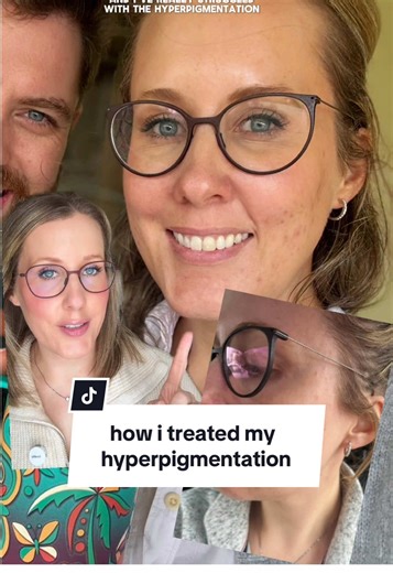 having acne prone, dry, scarred skin in your late thirties is SO frustrating, and it’s honestly hard to look at old pictures of my skin. here’s what has worked for me in the past year to fix my acne and hyperpigmentation. @Caudalie @skinbetter science @currentbody #hyperpigmentation #alpharet #venoperfect #intensepulselight #microneedling