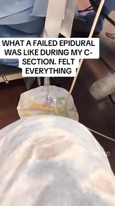 2.2M views · 11K reactions | What a failed anesthesia during a caesarean section looks like凉 mothers are super heroes honestly. May God bless all mother.  #pregnancy #trendingreelsvideo | NAMND | Facebook