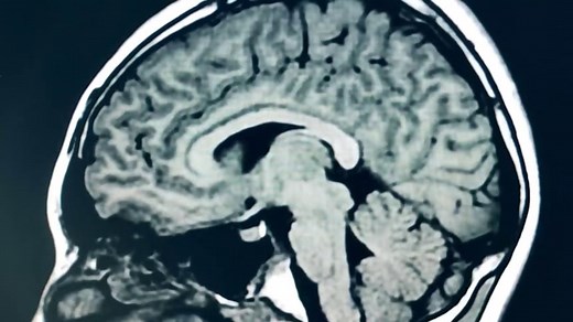 Covid attacking the brain may explain long-lasting symptoms