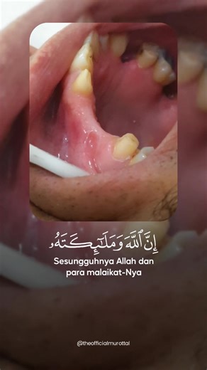 Pfm Dental crown #crowns #pfmcrown #dentalvideo #viral