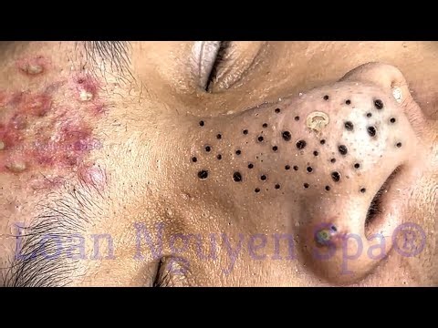 Blackhead Removal With Sac Dep Spa @100074663