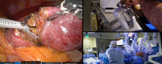 Robotic Hepatectomy for a Segment V/VI Suspected HCC Lesion with Cholecystectomy and Evaluation by Ultrasound and Excisional Biopsy of a Segment IVb Lesion | Journal of Medical Insight