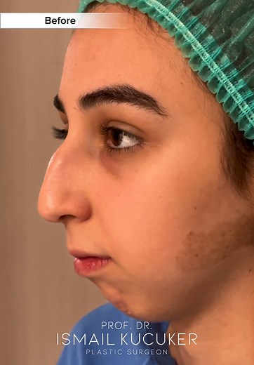 Chin Prosthesis and Nose Surgery Transformation