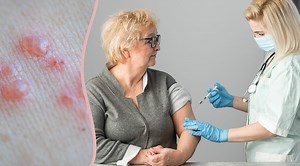 Nervsmärtor efter bältros – ska vaccinet fungera mot det?