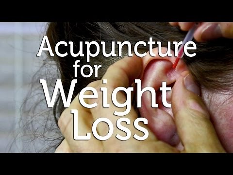 Acupuncture for Weight Loss