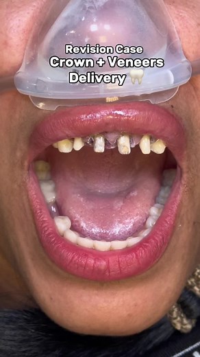Dental Crowns and Veneers Delivery Case Study
