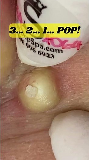 Biggest Bump On The Ear - Big Cyst #shorts