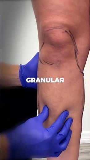 Achieving beautiful legs with lipedema liposuction