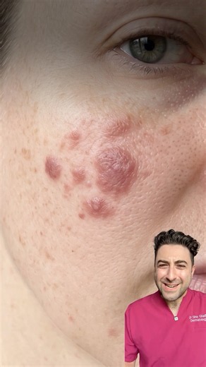 You Thought This Was Just “Acne”…