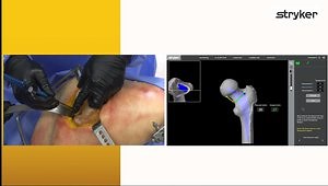 Mako Total Hip 4.0 - SmartRobotics™ Posterior Approach