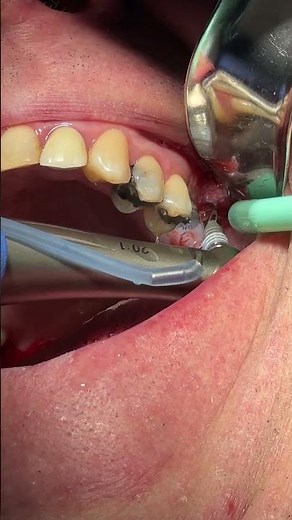 Preparing For an Implant!