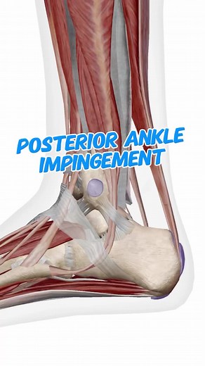 Posterior Ankle Impingement: Diagnosis & Pain Relief