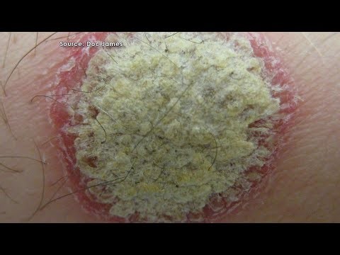 Psoriasis: New Biologic Treatments