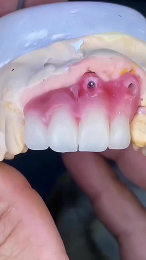 Transforming Smiles: Dental Lab Techniques for Beautiful Crowns and Veneers