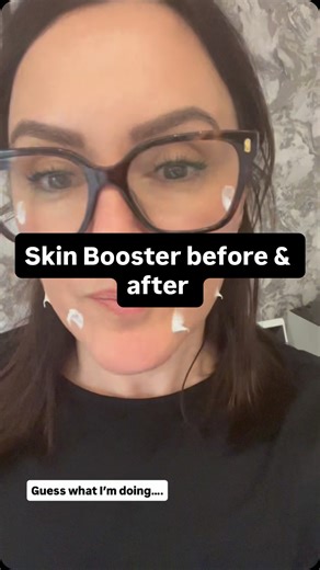Before & Immediately after - SKIN BOOSTER What is a skin booster? Injectable hydration, that reaches the deeper layers of the dermis. A great treatment for dehydrated skin that’s needing a Boost 🚀 #hydration #skinhealth #skincare #skinbooster | Hannah Eastwood Skin & Brow Specialist