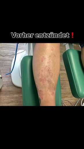 💚🦶 Vorher entzündet. Nachher beeindruckend ruhig. Moderne Medizin – berührungslos, aber wirkungsvoll. 🦠 Kaltplasma reduziert gezielt die Keimlast, unterstützt die Regeneration und beruhigt die Wundumgebung. ✂️ Keine Hautverletzung. 😌 Kein Schmerz. 💥 Nur Wirkung. 👉 Du willst wissen, wie das funktioniert? Ich zeig’s dir. www.feine-fuesse.de im Herzen BarFuß 💚🦶 #kaltplasma #podologie #wundheilung #fußgesundheit #barfußaufbali #drplajin | Christiane Schöpe