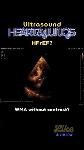#WMA in #echocardiography - without contrast